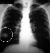 Diagnósticos de una radiopacidad en una radiografía de tórax