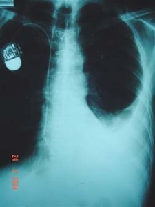 Diagnósticos de una radiopacidad en una radiografía de tórax