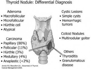 Nódulo tiroideo