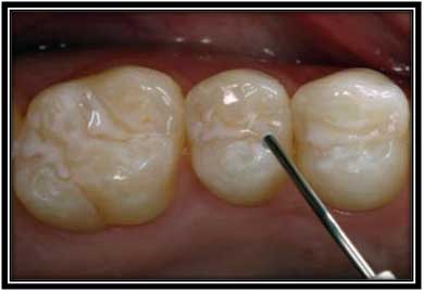 Sellantes Dentarios, Usos y Evaluación