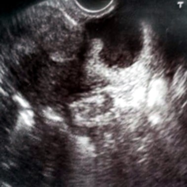 Istmocele
